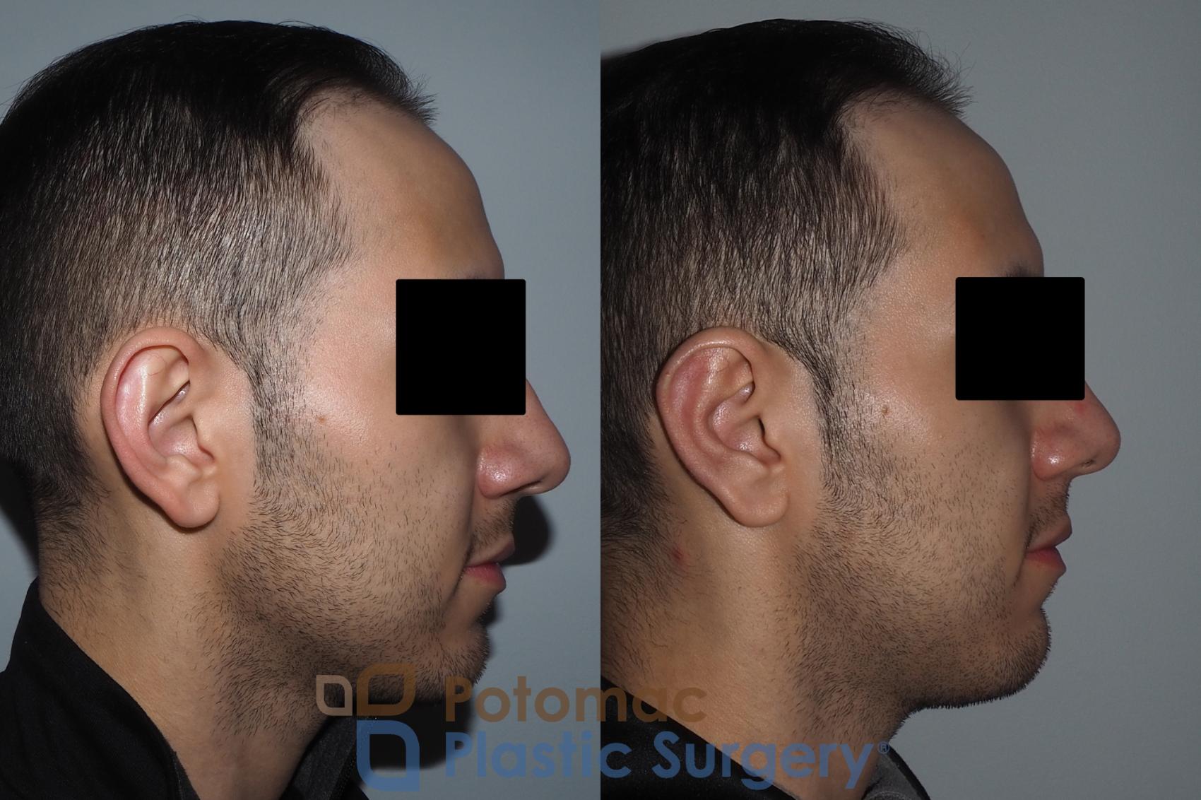 Before & After Otoplasty Case 217 Right Side View in Washington, DC