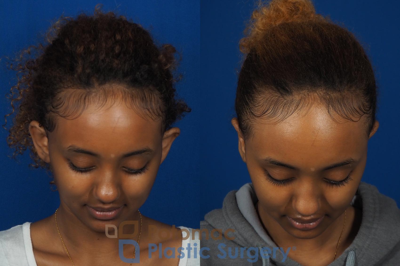 Before & After Otoplasty Case 239 Above View in Washington, DC