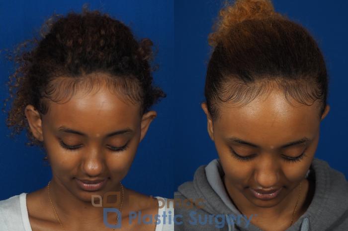 Before & After Otoplasty Case 239 Above View in Washington DC & Arlington , DC