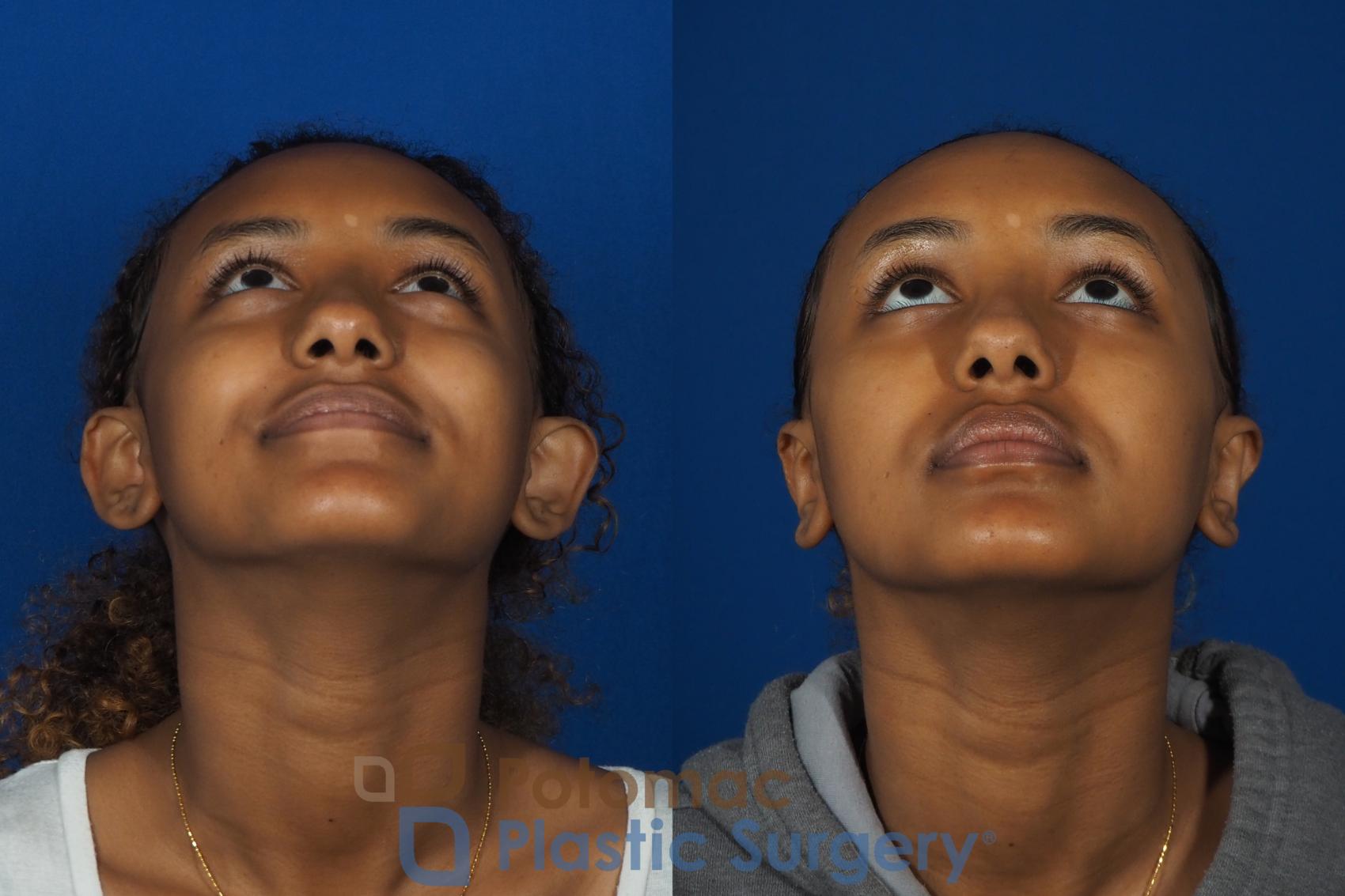 Before & After Otoplasty Case 239 Below View in Washington, DC