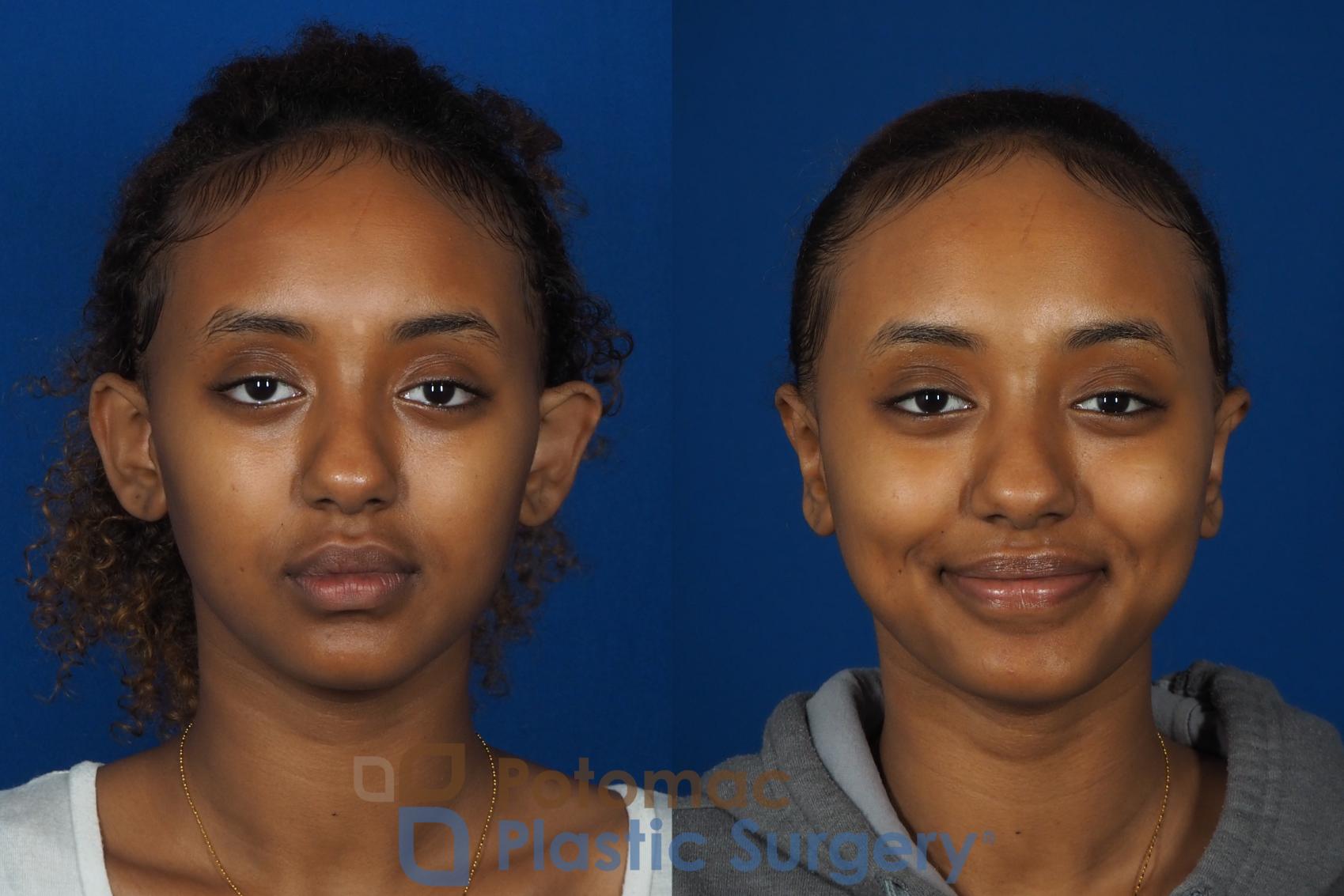 Otoplasty To Pin Back The Ears Of A Younger Woman 0689