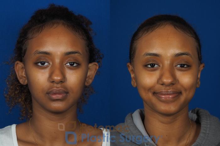 Before & After Otoplasty Case 239 Front View in Washington DC & Arlington , DC