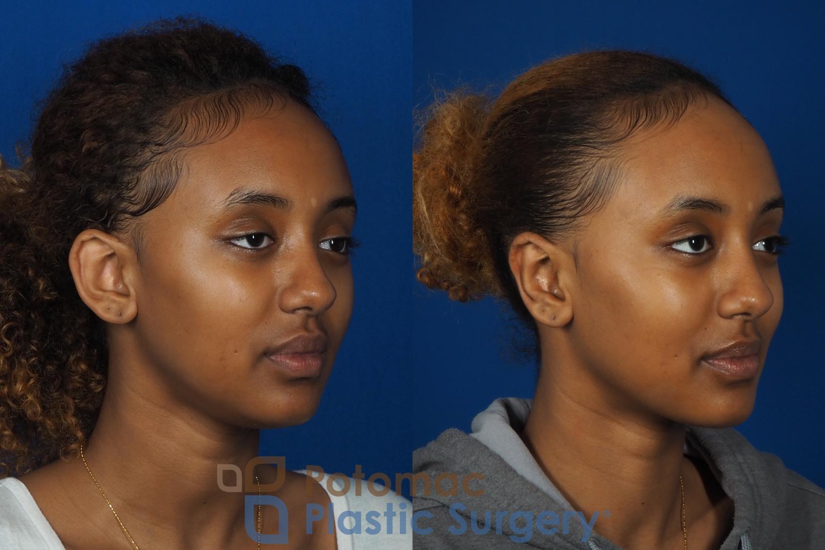 Before & After Otoplasty Case 239 Right Oblique View in Washington, DC