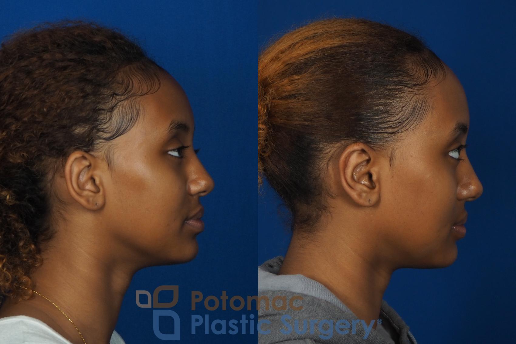 Before & After Otoplasty Case 239 Right Side View in Washington, DC