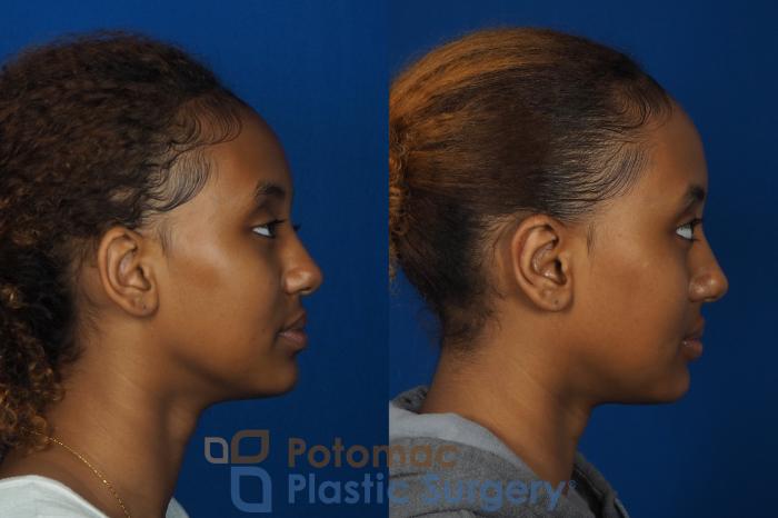 Before & After Otoplasty Case 239 Right Side View in Washington DC & Arlington , DC