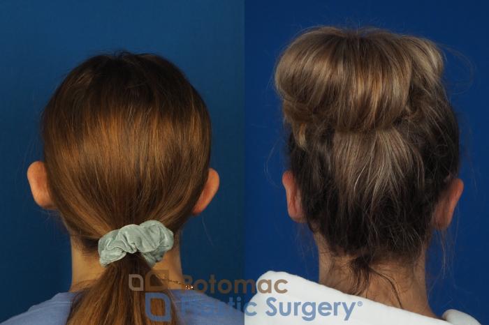 Before & After Otoplasty Case 250 Back View in Washington DC & Arlington , DC