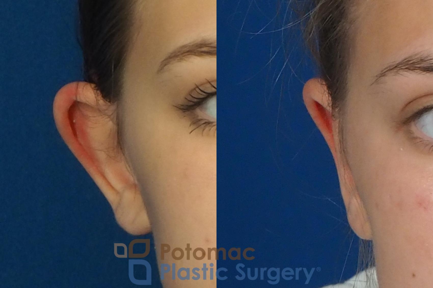 Before & After Otoplasty Case 250 Front View in Washington, DC