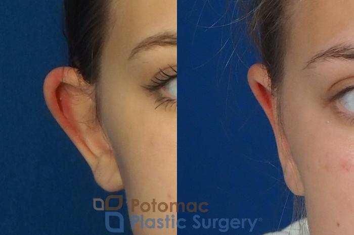 Before & After Otoplasty Case 250 Front View in Washington DC & Arlington , DC