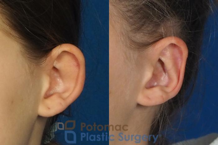 Before & After Otoplasty Case 250 Left Oblique View in Washington DC & Arlington , DC