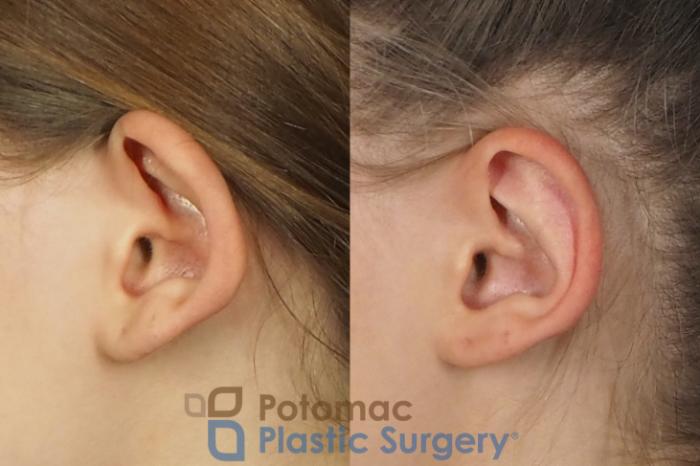 Before & After Otoplasty Case 250 Left Side View in Washington DC & Arlington , DC