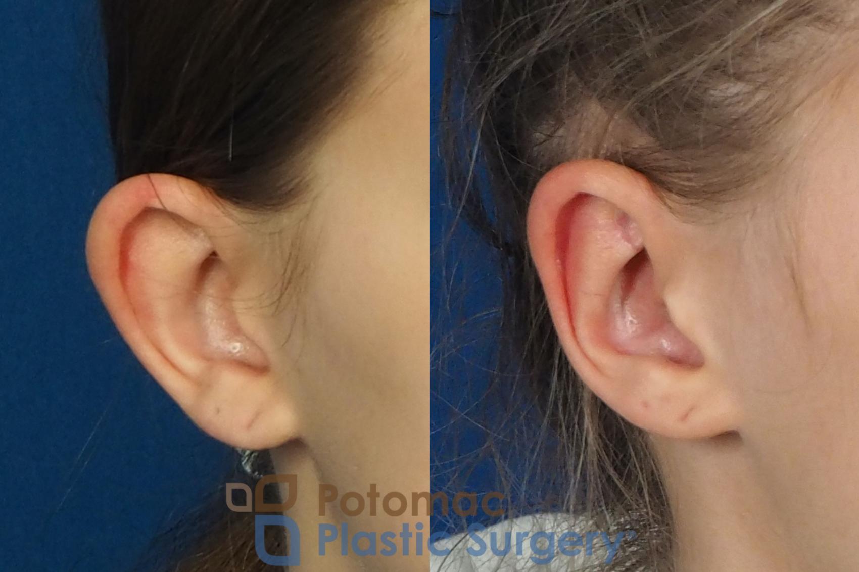 Before & After Otoplasty Case 250 Right Oblique View in Washington DC & Arlington , DC