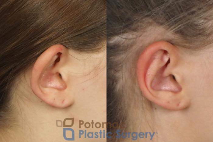 Before & After Otoplasty Case 250 Right Side View in Washington DC & Arlington , DC