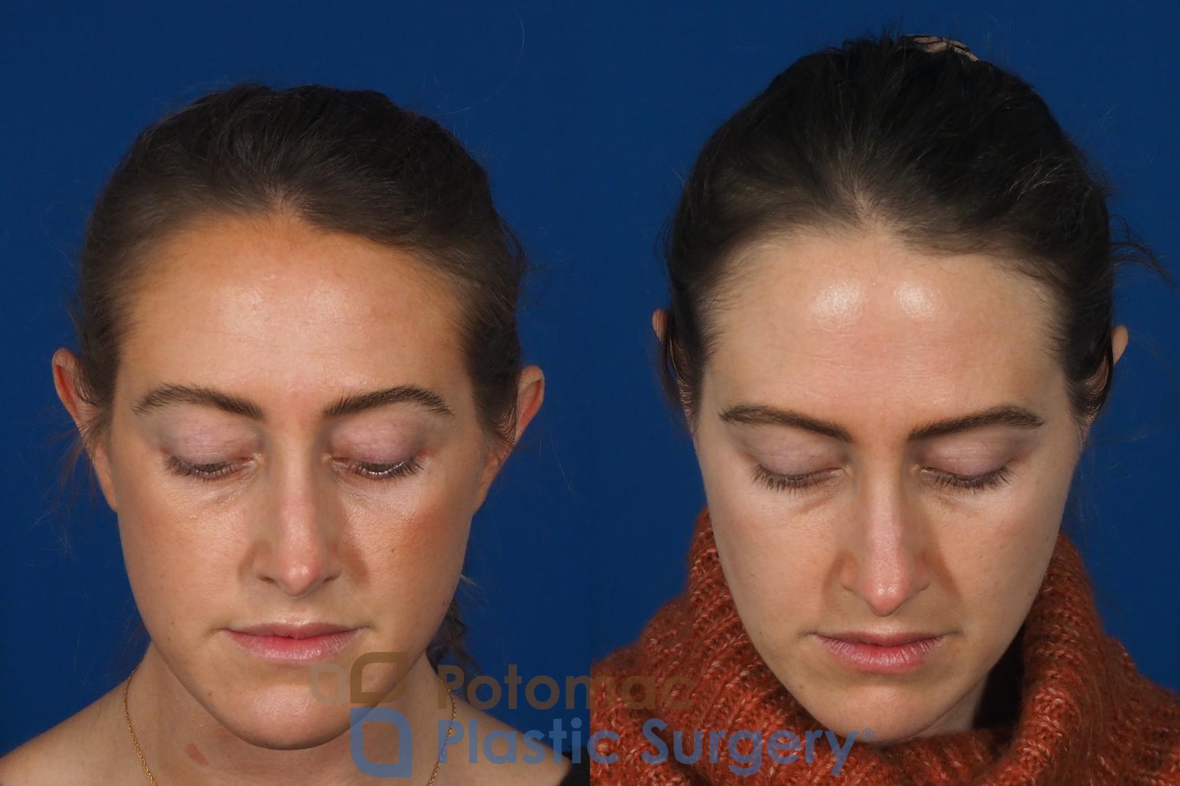 Before & After Otoplasty Case 257 Above View in Washington, DC