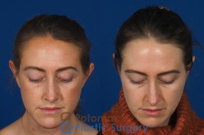 Before & After Otoplasty Case 257 Above View in Washington DC & Arlington , DC