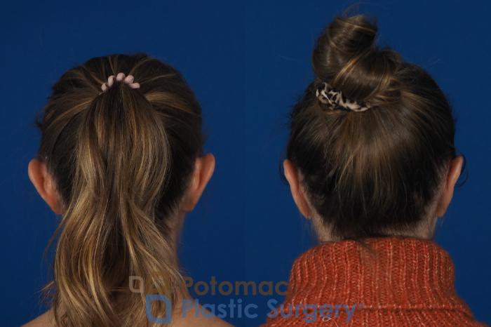 Before & After Otoplasty Case 257 Back View in Washington DC & Arlington , DC