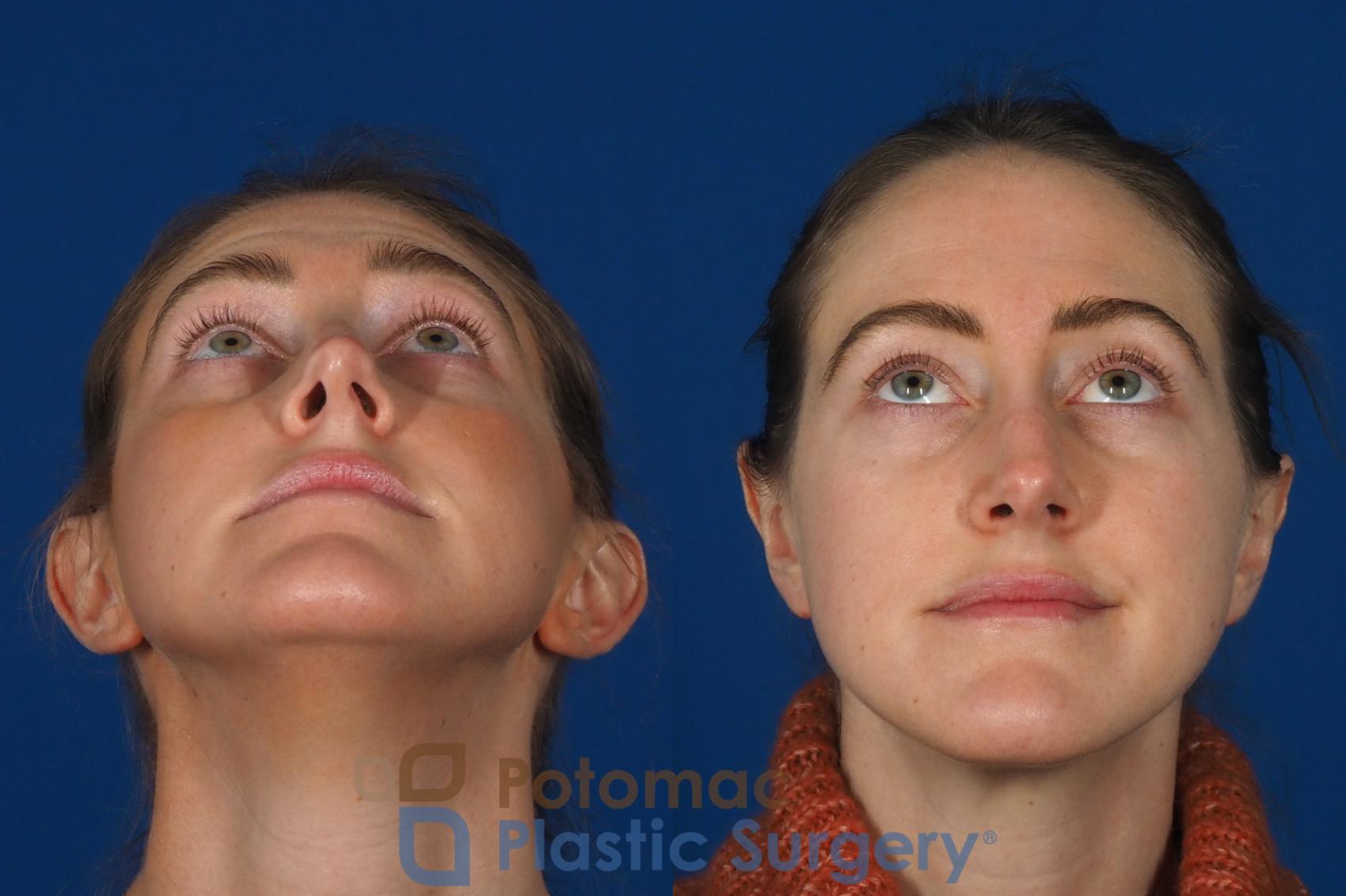 Before & After Otoplasty Case 257 Below View in Washington, DC