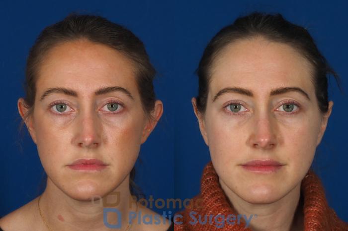 Before & After Otoplasty Case 257 Front View #1 View in Washington DC & Arlington , DC
