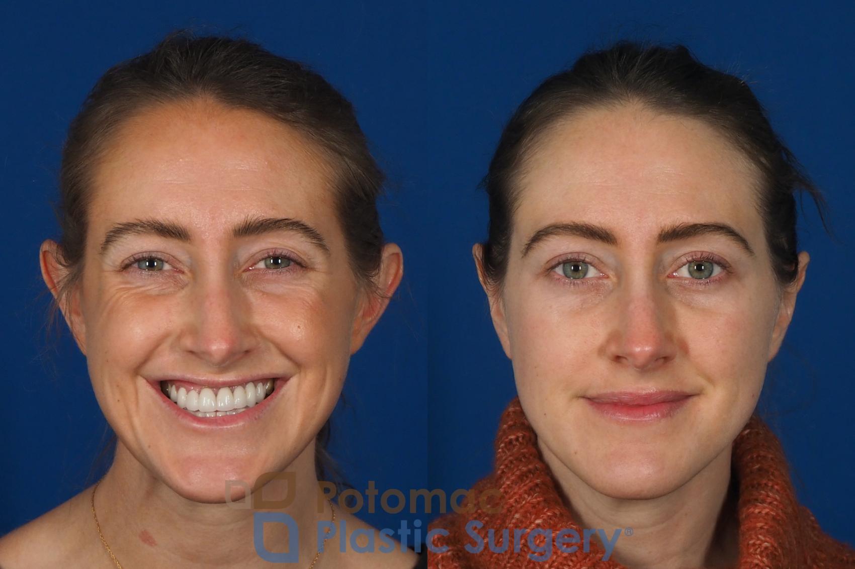 Before & After Otoplasty Case 257 Front View #2 View in Washington, DC