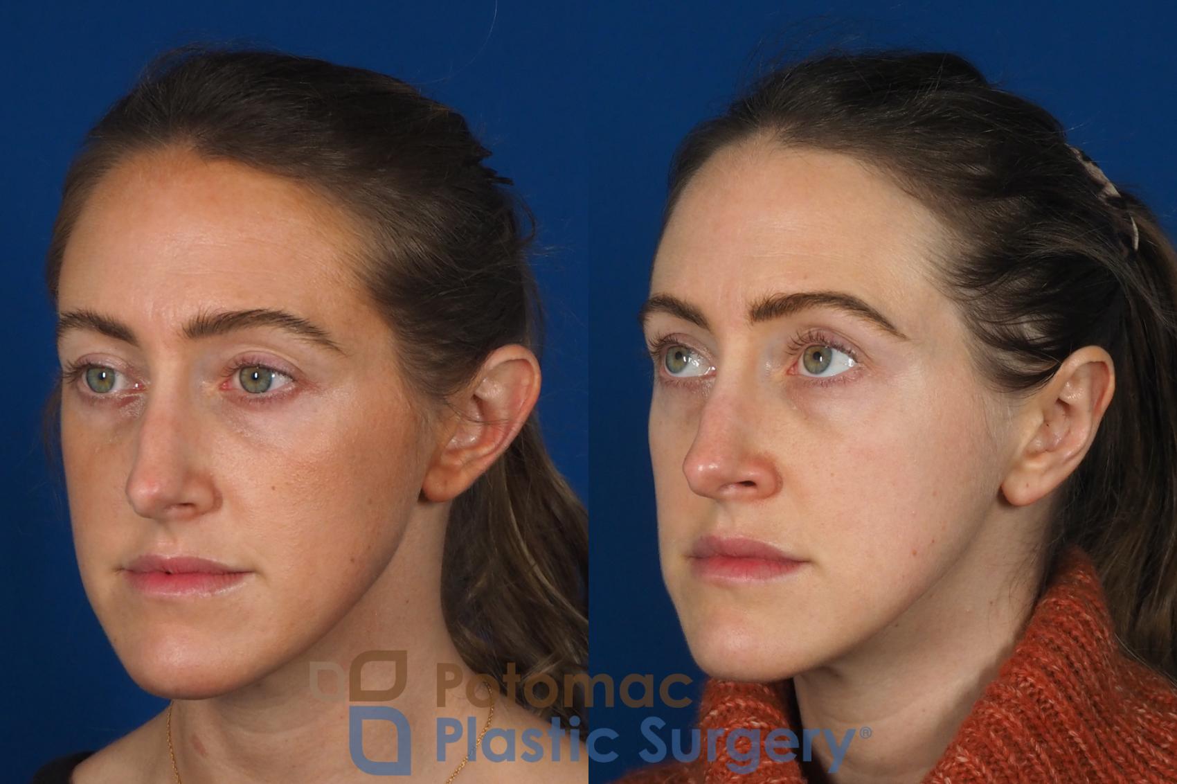 Before & After Otoplasty Case 257 Left Oblique View in Washington, DC