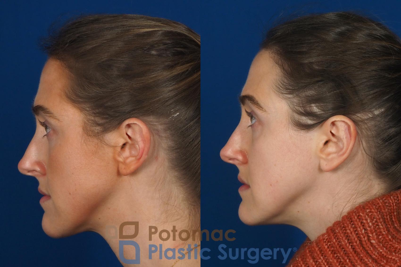 Before & After Otoplasty Case 257 Left Side View in Washington, DC