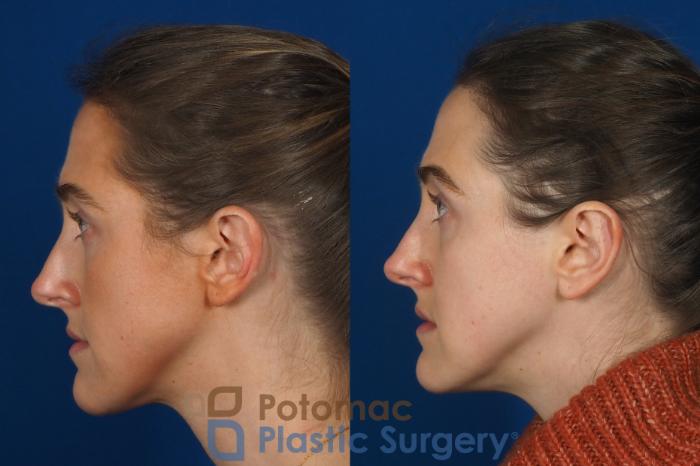 Before & After Otoplasty Case 257 Left Side View in Washington DC & Arlington , DC
