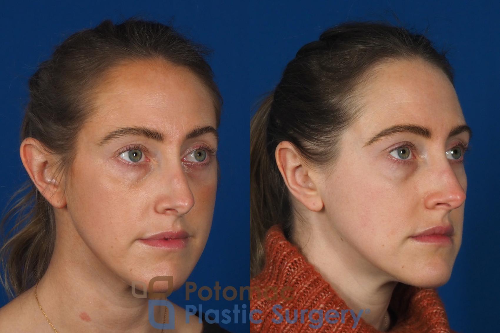 Before & After Otoplasty Case 257 Right Oblique View in Washington, DC