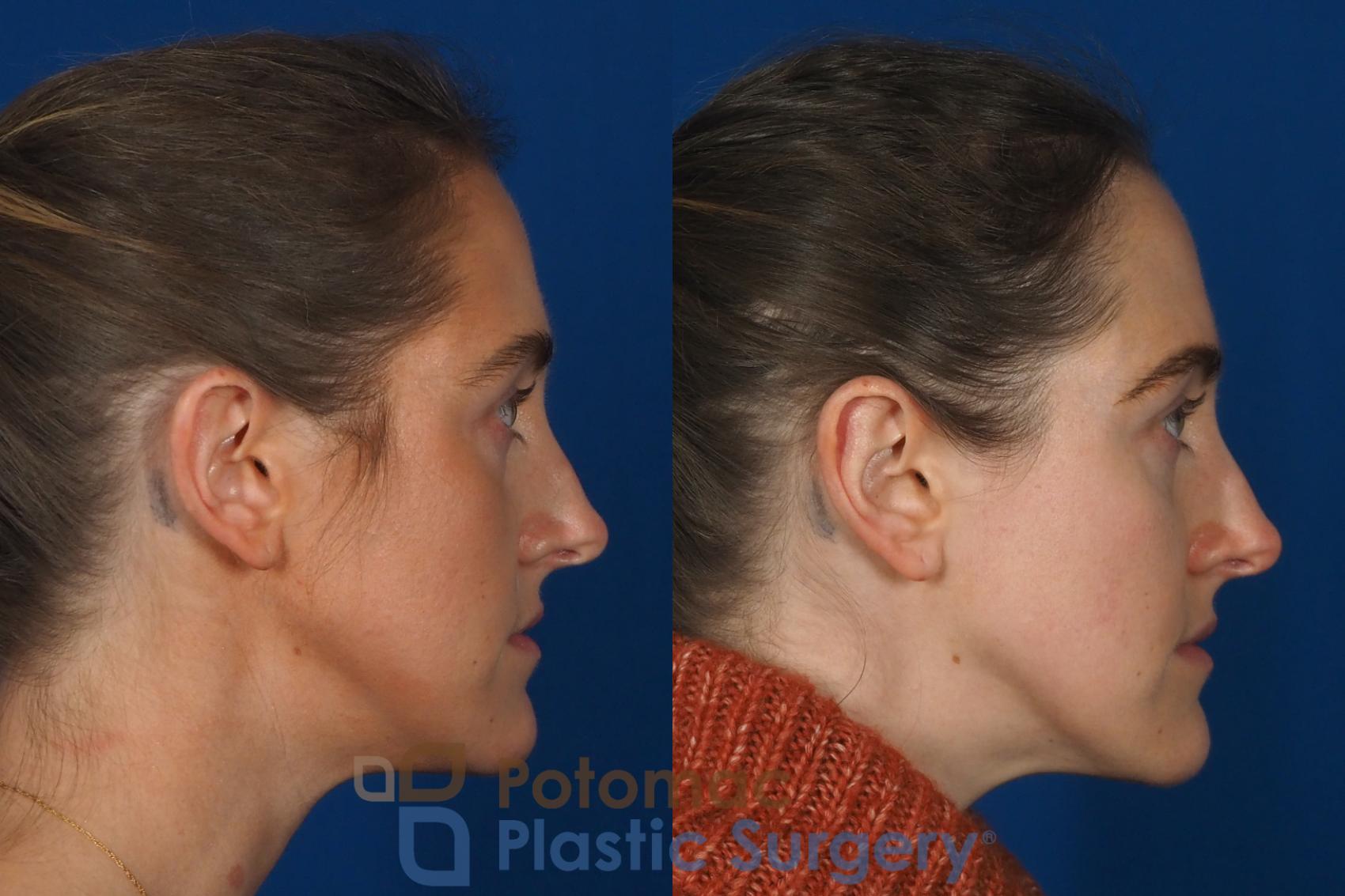 Before & After Otoplasty Case 257 Right Side View in Washington, DC