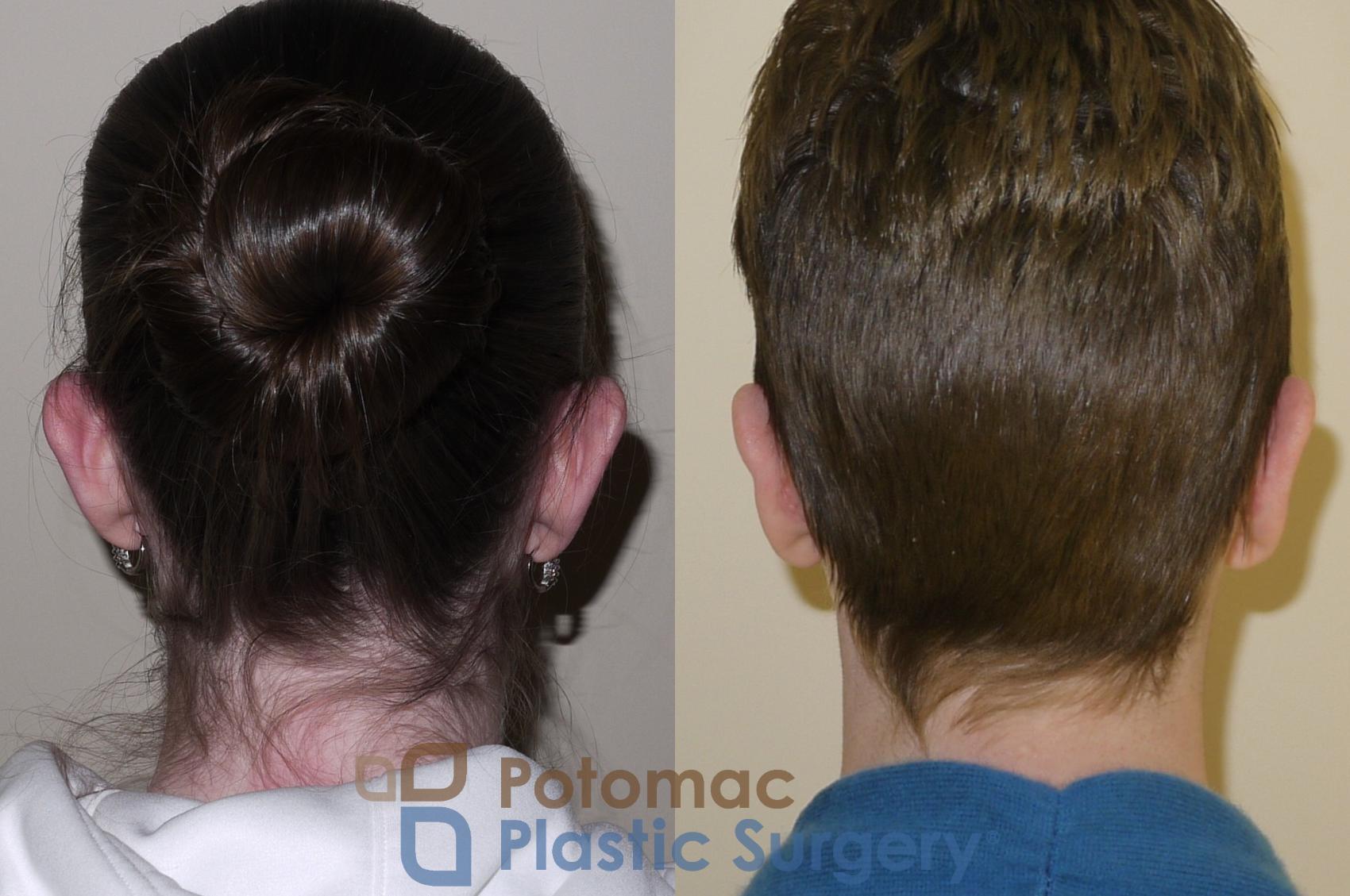 Before & After Otoplasty Case 47 Back View in Washington, DC