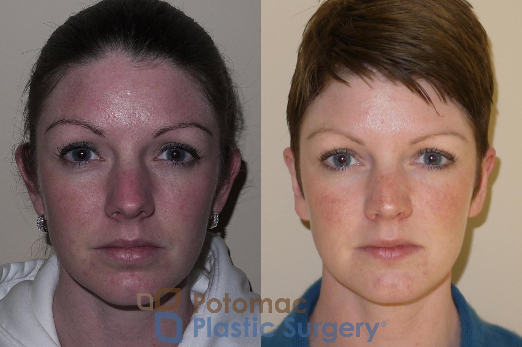 Before & After Otoplasty Case 47 Front View in Washington, DC