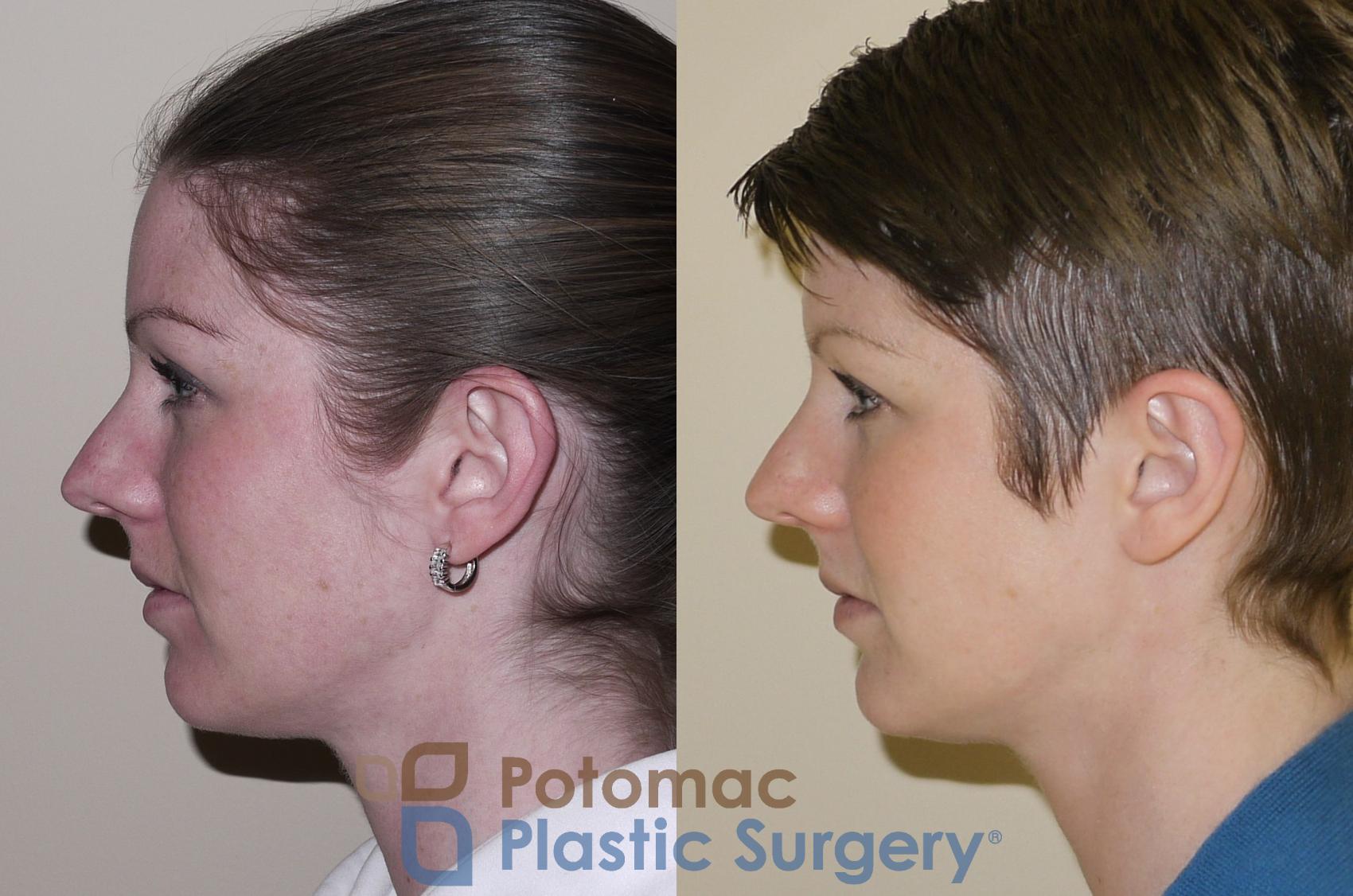 Before & After Otoplasty Case 47 Left Side View in Washington, DC