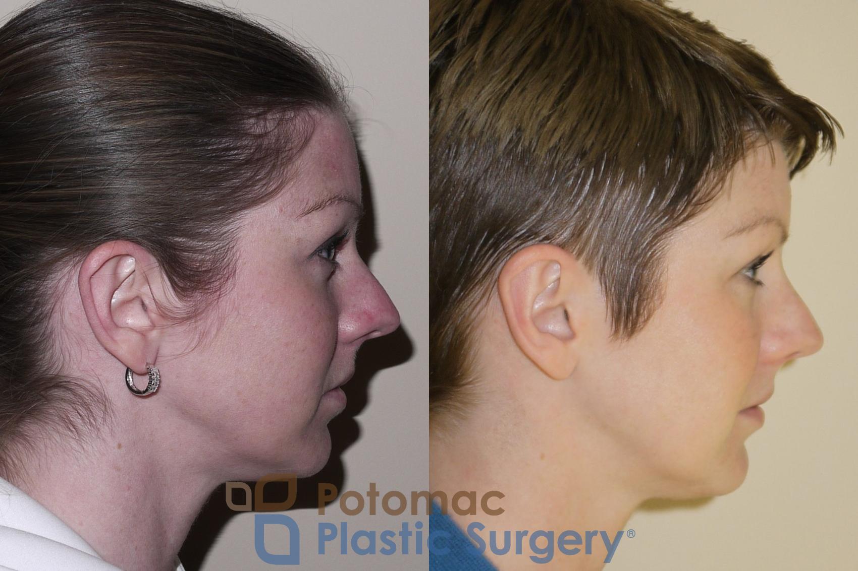 Before & After Otoplasty Case 47 Right Side View in Washington, DC