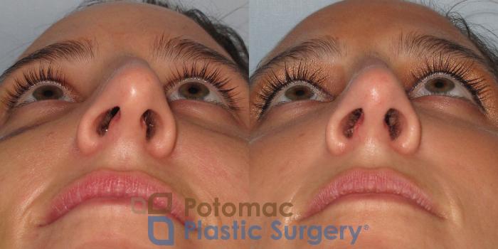 Before & After Rhinoplasty - Cosmetic Case 1 Below View in Washington DC & Arlington , DC