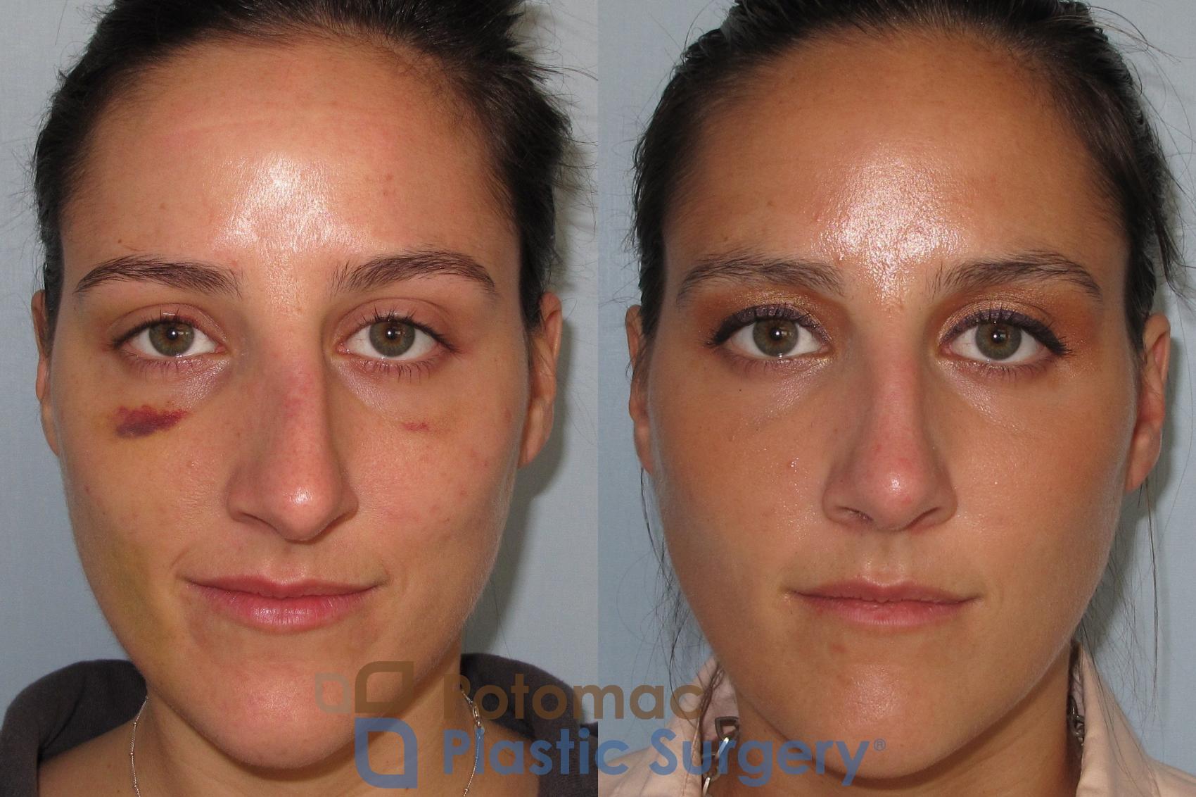 Before & After Rhinoplasty - Cosmetic Case 1 Front View in Washington, DC