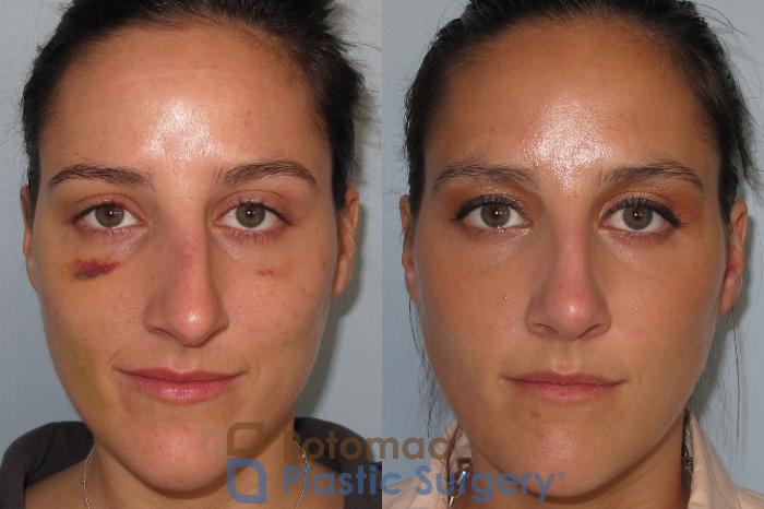 Before & After Rhinoplasty - Cosmetic Case 1 Front View in Washington DC & Arlington , DC