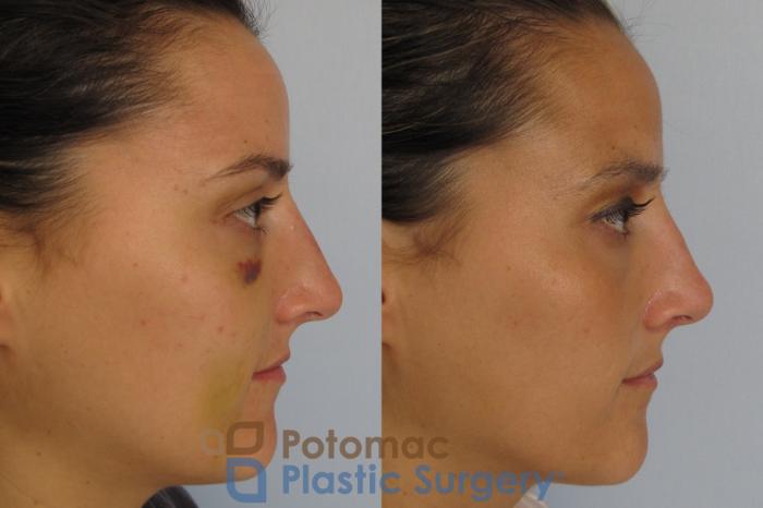 Before & After Rhinoplasty - Medical Case 1 Right Side View in Washington DC & Arlington , DC