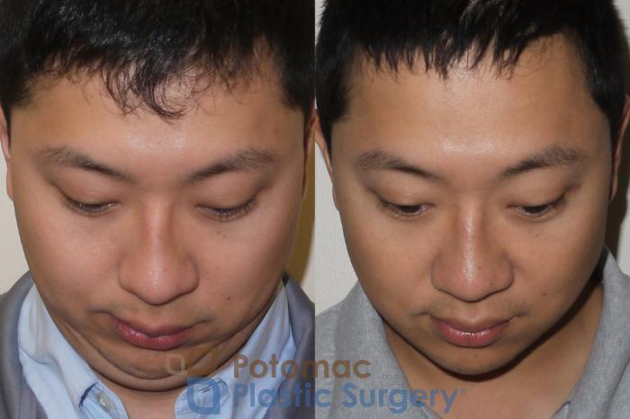 Before & After Rhinoplasty - Cosmetic Case 105 Above View in Washington DC & Arlington , DC