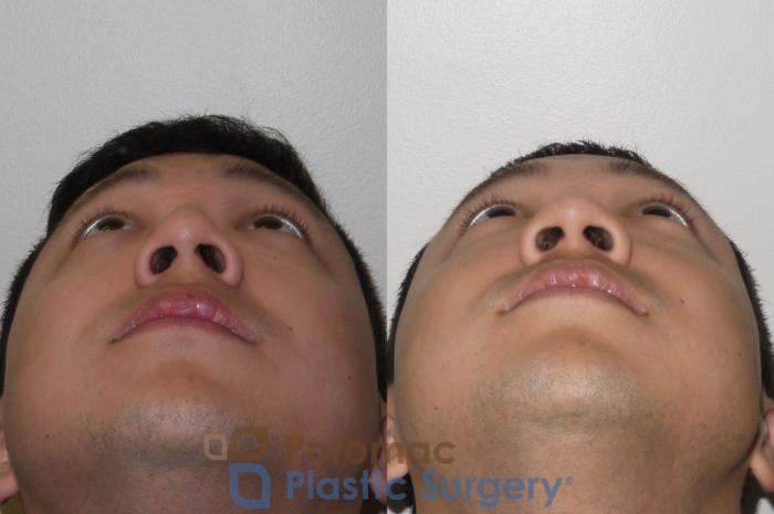 Before & After Rhinoplasty - Medical Case 105 Below View in Washington DC & Arlington , DC