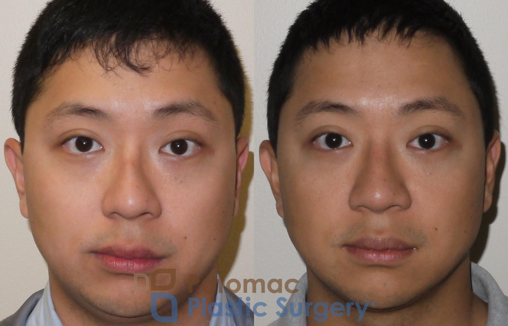 Before & After Rhinoplasty - Medical Case 105 Front View in Washington, DC