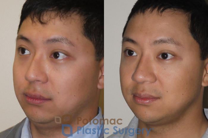 Before & After Rhinoplasty - Cosmetic Case 105 Left Oblique View in Washington DC & Arlington , DC