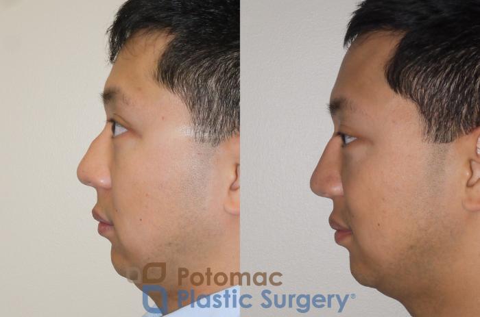 Before & After Rhinoplasty - Medical Case 105 Left Side View in Washington DC & Arlington , DC