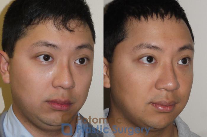Before & After Rhinoplasty - Medical Case 105 Right Oblique View in Washington DC & Arlington , DC