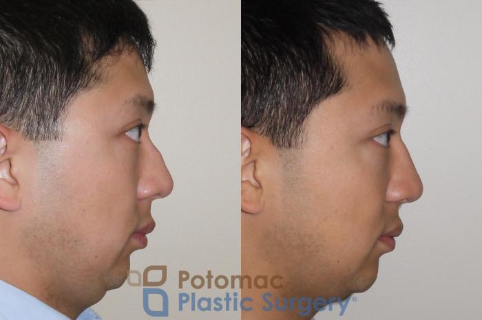 Before & After Rhinoplasty - Medical Case 105 Right Side View in Washington DC & Arlington , DC