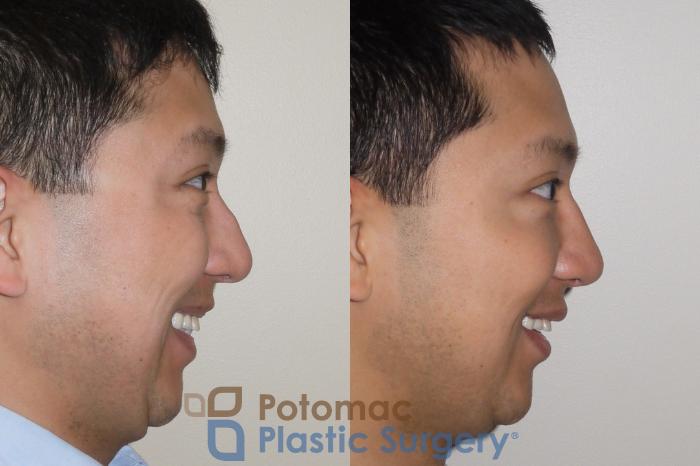 Before & After Rhinoplasty - Cosmetic Case 105 Right Side View #2 View in Washington DC & Arlington , DC