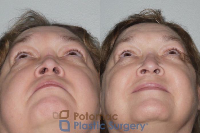 Before & After Rhinoplasty - Cosmetic Case 106 Below View in Washington DC & Arlington , DC