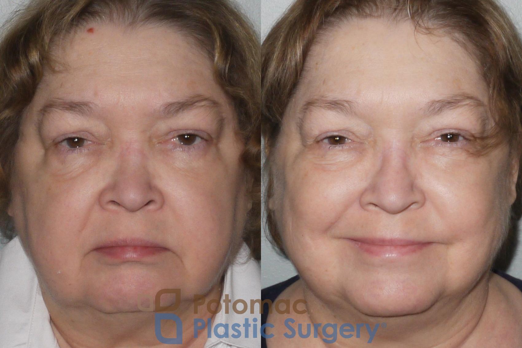 Before & After Rhinoplasty - Cosmetic Case 106 Front View in Washington, DC