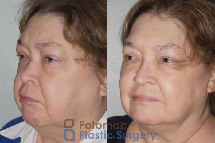 Before & After Rhinoplasty - Cosmetic Case 106 Left Oblique View in Washington DC & Arlington , DC