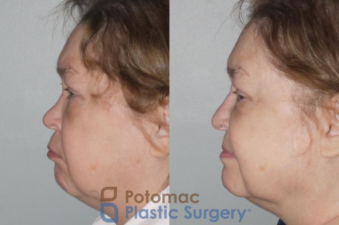 Before & After Rhinoplasty - Cosmetic Case 106 Left Side View in Washington DC & Arlington , DC