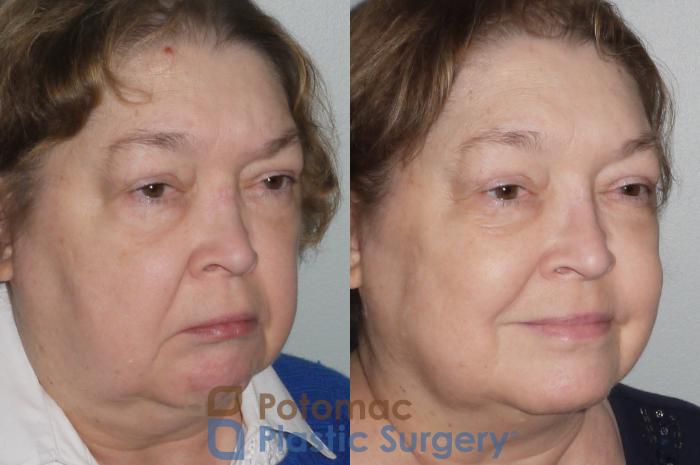 Before & After Rhinoplasty - Cosmetic Case 106 Right Oblique View in Washington DC & Arlington , DC