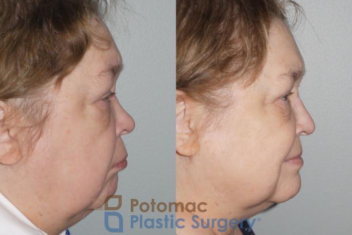 Before & After Rhinoplasty - Cosmetic Case 106 Right Side View in Washington DC & Arlington , DC