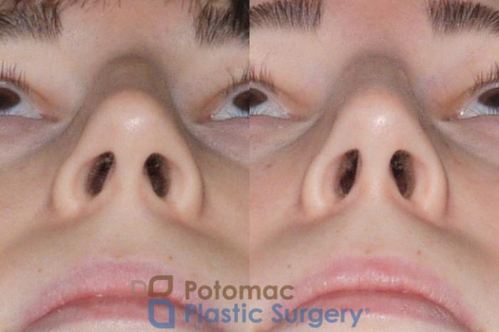 Before & After Rhinoplasty - Cosmetic Case 107 Below View in Washington DC & Arlington , DC
